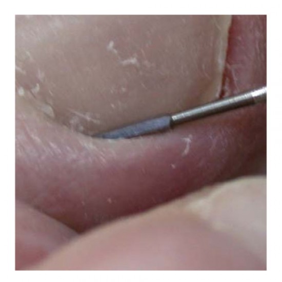 BUR ONY-clean 406L-RS-012