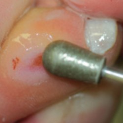 Diamond grinding frezy  830-070